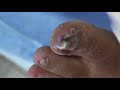 Ep_2007 Toenail removal 👣 เล็บม้วน..ตัดอย่างไร? 1  😷 (This clip is from Thailand)