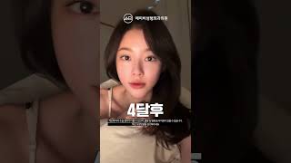 광대축소술+사각턱수술+피질절골 후기 #shorts