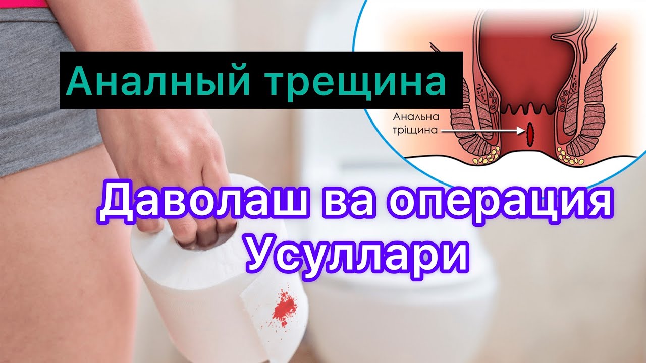 Анальный трещина( анал ёриги)ни даволаш ва Операция усуллари хакида( +99890 940 9209)