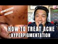 How to treat ACNE PIGMENTATION | PIH