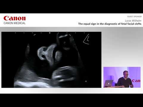 ISUOG 2019 - Lucas Wilhelm on  the “equal sign” in the diagnosis of fetal facial clefts