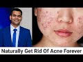 Naturally get rid of acne forever/Get acne Removed|DR VIVEK JOSHI