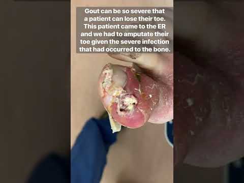 GOUT SO SEVERE IT DESTROYED BIG TOE UNREAL Shorts