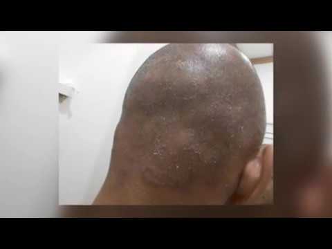 Video: Rawatan Alopecia Dengan Ubat-ubatan