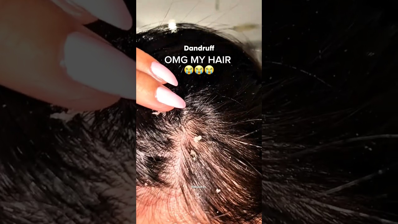 Зуд кожи головы и перхоть? Попробуйте это средство с нимом! 