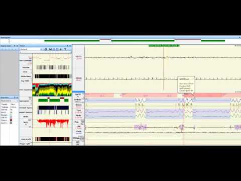 Sleep Study Data-