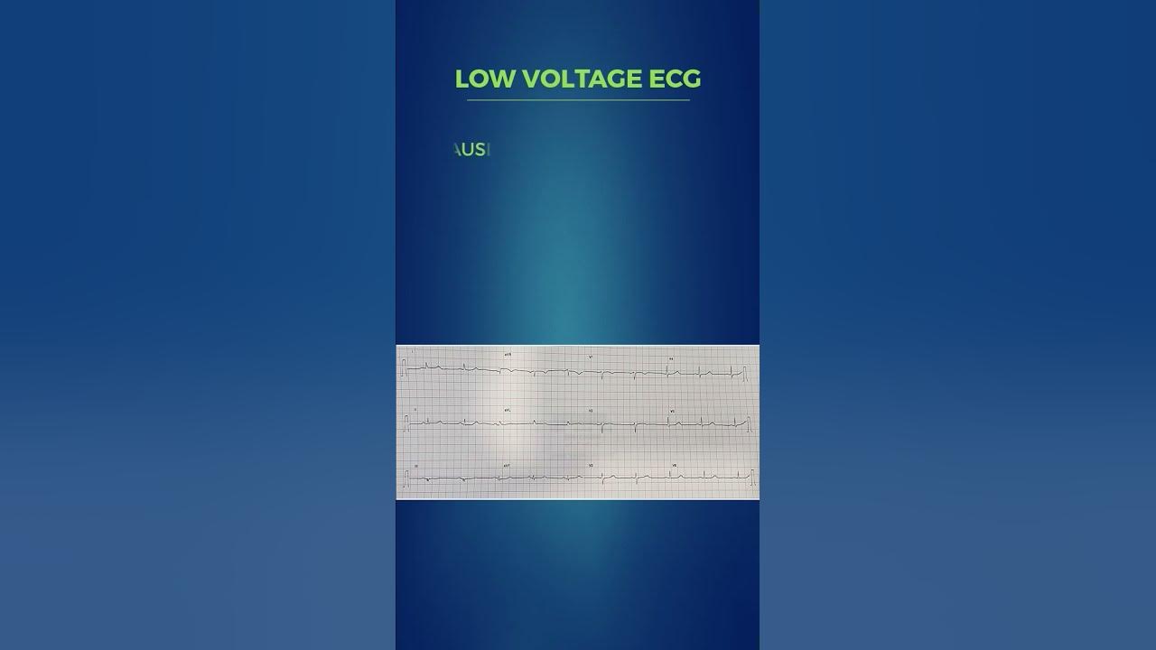 Low Voltage ECG - Criteria & Causes | Short in a Minute - YouTube