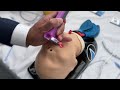 Bebe vie tm by adroit surgical intro  and demo of how to use oct 2022