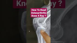 How To Read Osteoarthritis Knee X Ray Dr Sai Chandra MBBS DNB Ortho