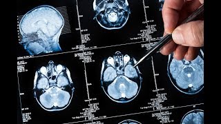 Treatment of Brain Metastases: New Evidence, New Options