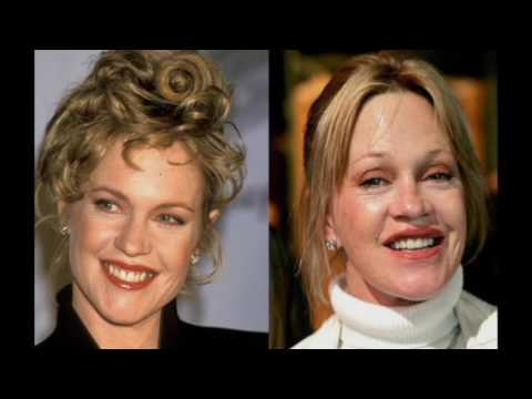 Celebrity Plastic Surgery | Celebrities Plastic Surgery Transformations @spectacularvideos833