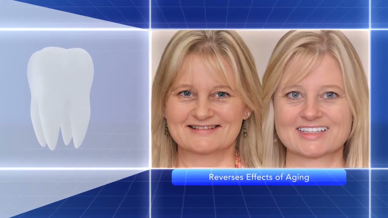 How to Get Rid of an Unsightly Overbite for Good, Byte®