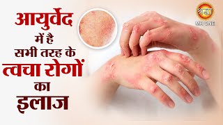 आयुर्वेद में है सभी तरह के त्वचा रोगों का इलाज | Skin disease treatment ayurveda | Ayurveda Chikitsa