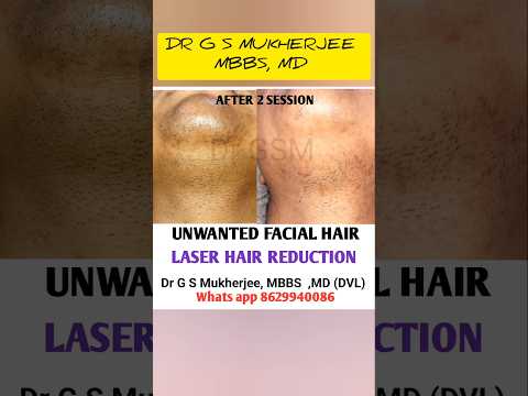 Unwanted Facial Hair Hair Removal Treatment Laser Hair Removal Hairremoval Drgsmukherjee 