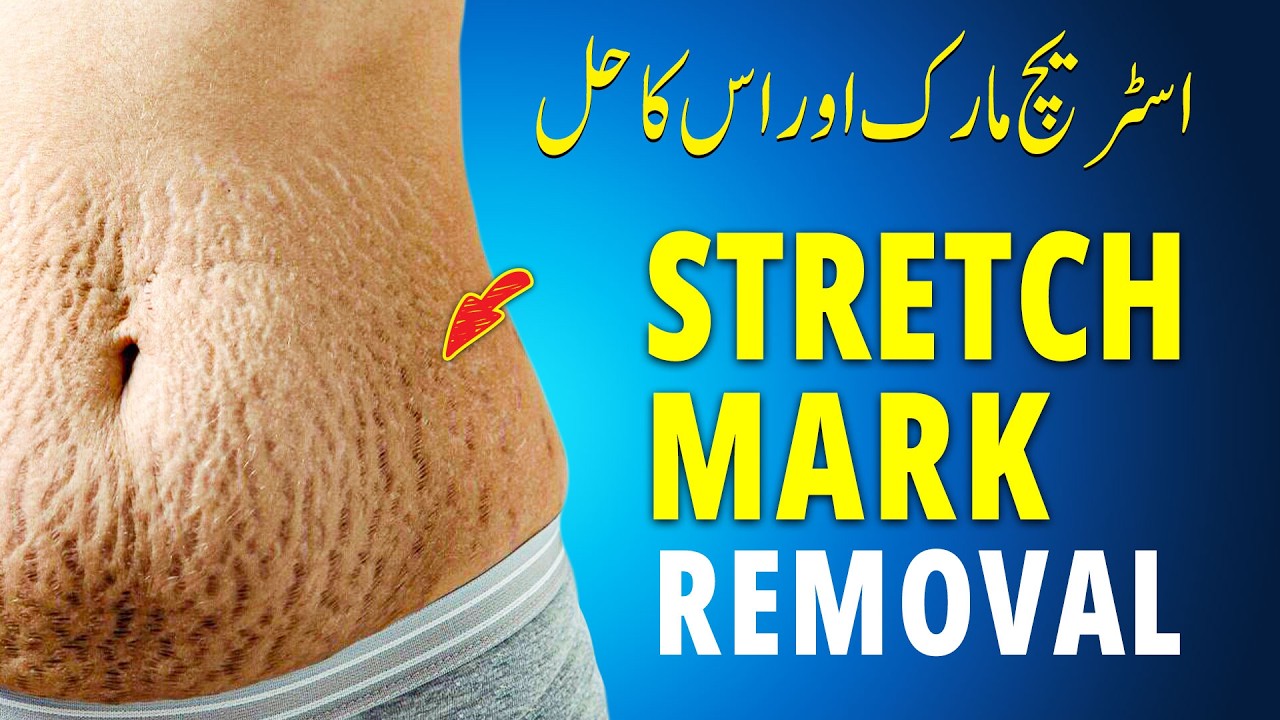 Do Stretch Mark Removal Techniques Even Work? | Stretch Marks Kaise Kam Karen