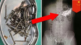 Man swallows 87 nails, 7 push pins after fight with gf - TomoNews