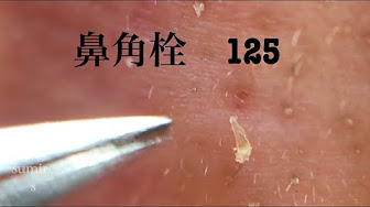 Nan Nan Back Skip Navigation Search Search Sign In Home Home Explore Explore Shorts Shorts Subscriptions Subscriptions Library Library History History 92 Unavailable Videos Are Hidden Play All Tweezers Only Blackheads ピンセットのみ使用 角