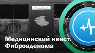 картинка: Медицинский квест. Фиброаденома