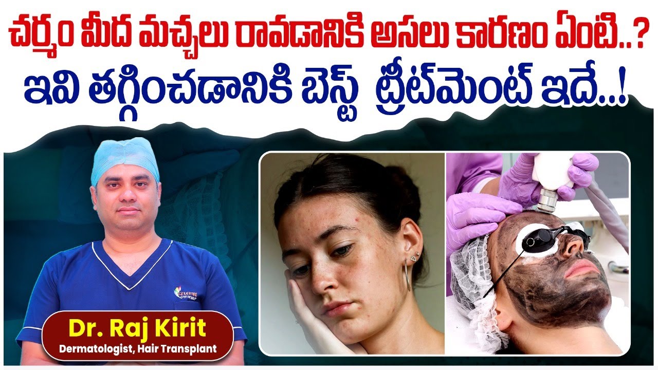 Lichen Planus Pigmentosus Treatment in Telugu || Ashy Dermatosis || Celestee Skin And Hair Clinic