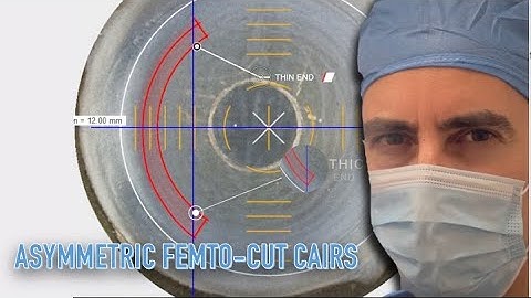 Asymmetric Femto-cut CAIRS by Dr. Shady Awwad using the Ziemer LDV Z8