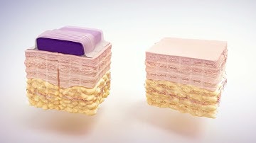 Werkingsmechanismen Prevena