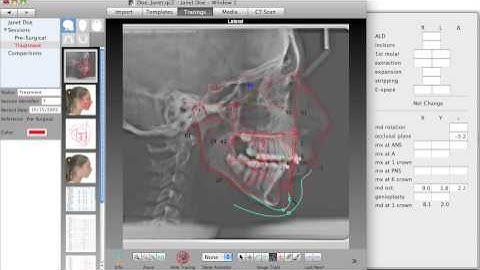 Quick Ceph Studio - Treatment Planning and Morphing