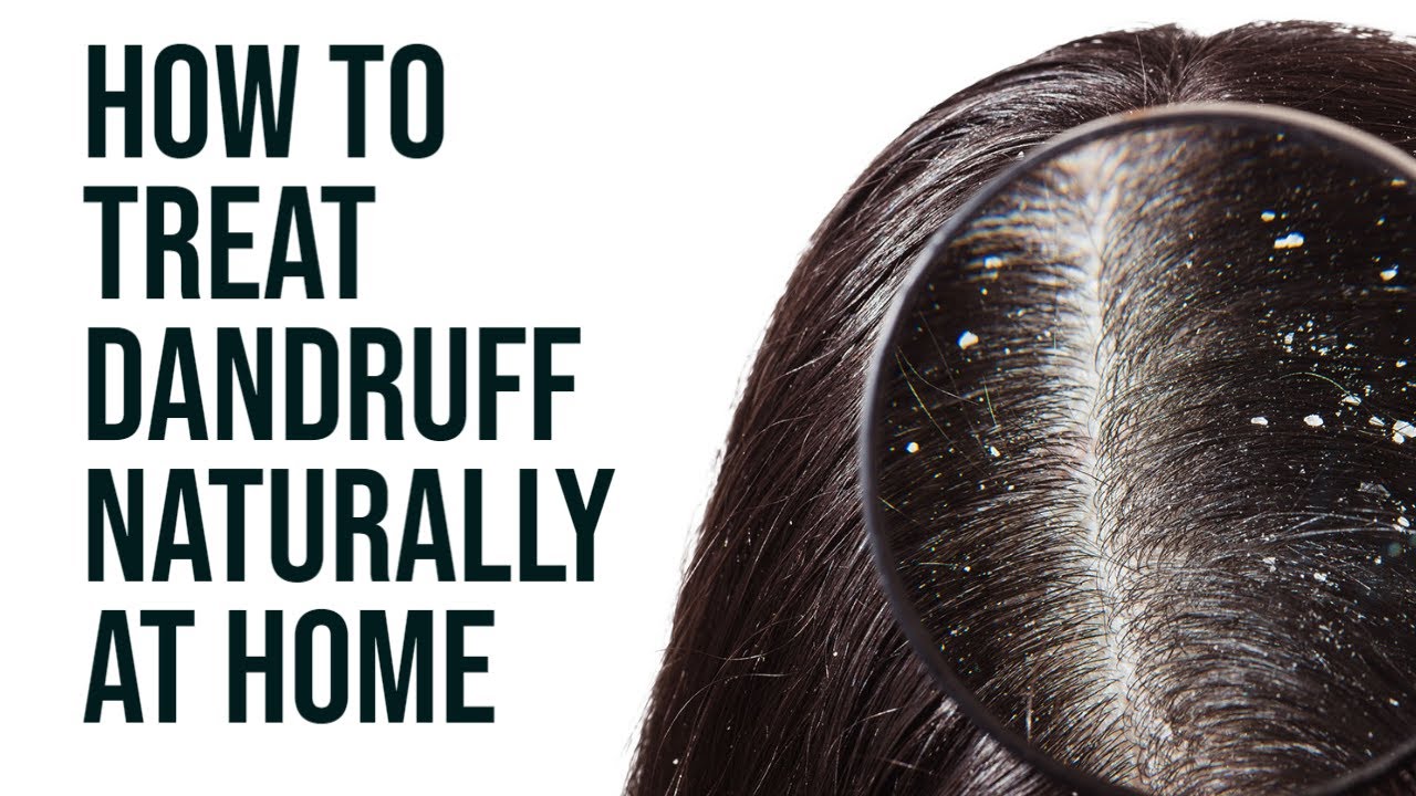 How to Treat Dandruff at Home YouTube