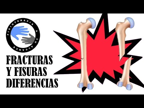 Vídeo: Diferencia Entre Fractura Y Rotura