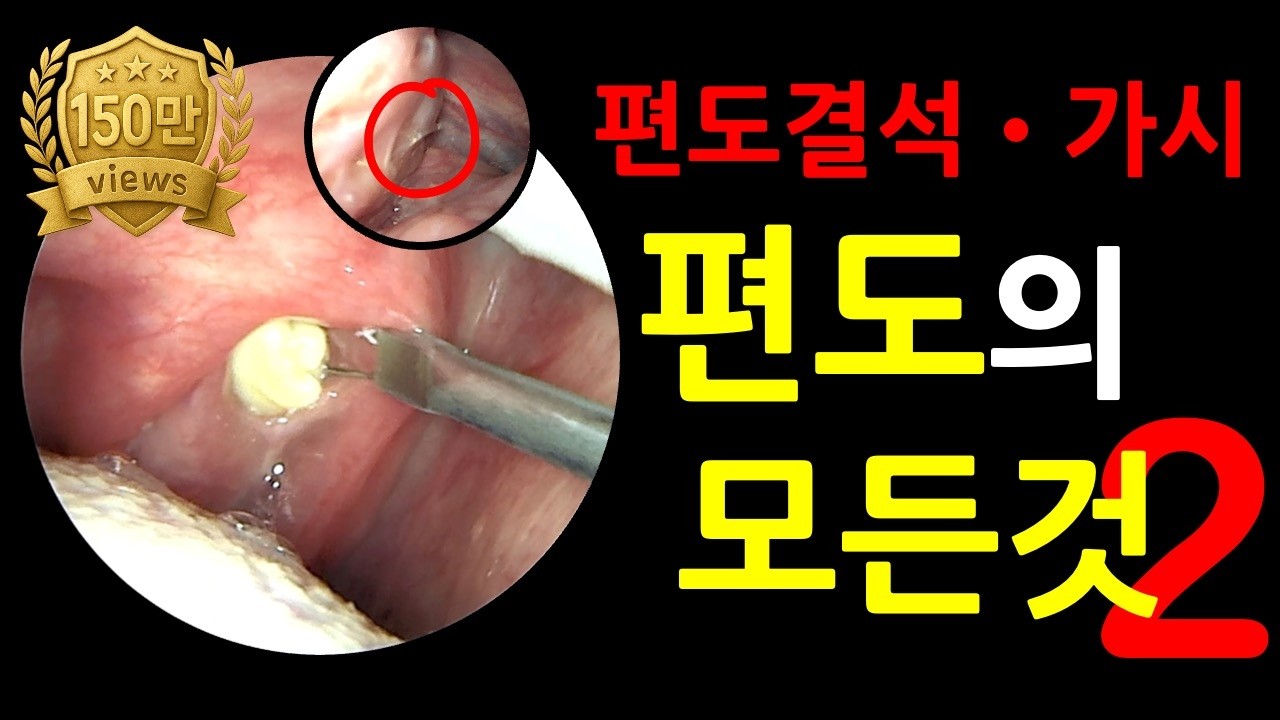 이비인후과 편도결석 편도가시 제거 내시경 영상 #tonsilstones