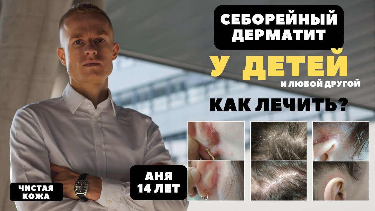 Лечение дерматита у детей. Пример лечения себорейного дерматита на ...