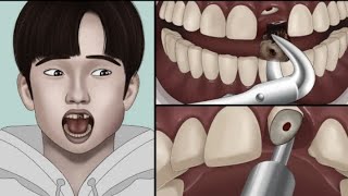 ASMR Satisfying symbios socket preservation | Teeth cavity treatment animation