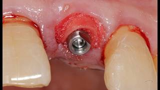 Immediate Implantation With Easy Bone Graft