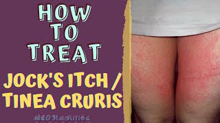 HOW TO TREAT JOCK'S ITCH \/ TINEA CRURIS