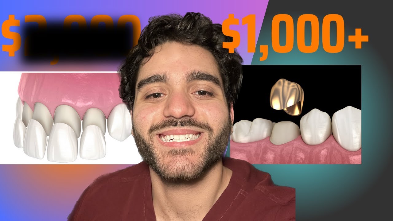 The Truth About Veneers YouTube