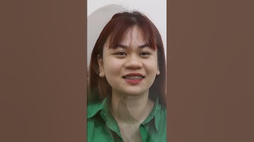 Thay đổi ngoạn mục sau niềng răng khấp hô | #shorts