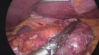 İkinci Kez Mide Küçültmere Sleeve Gastrektomi Ameliyatı