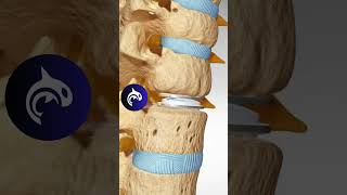 Cervical Disc Replacement Without Retractor | 4K 3D Spine Surgery #Shorts