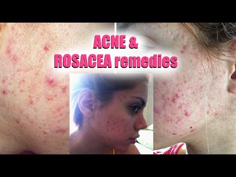 HOW TO GET RID OF ACNE AND ROSACEA || Pershii