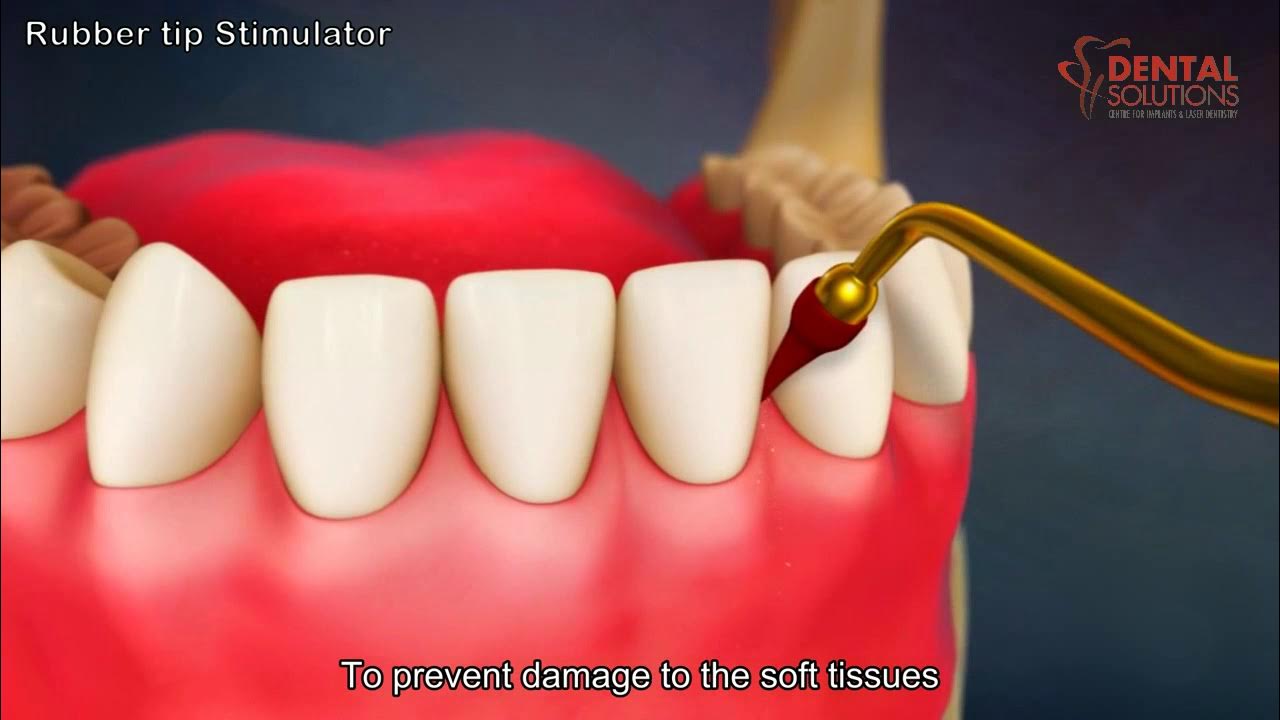 how-to-use-a-rubber-tip-gum-stimulator-work-3d-animation-video