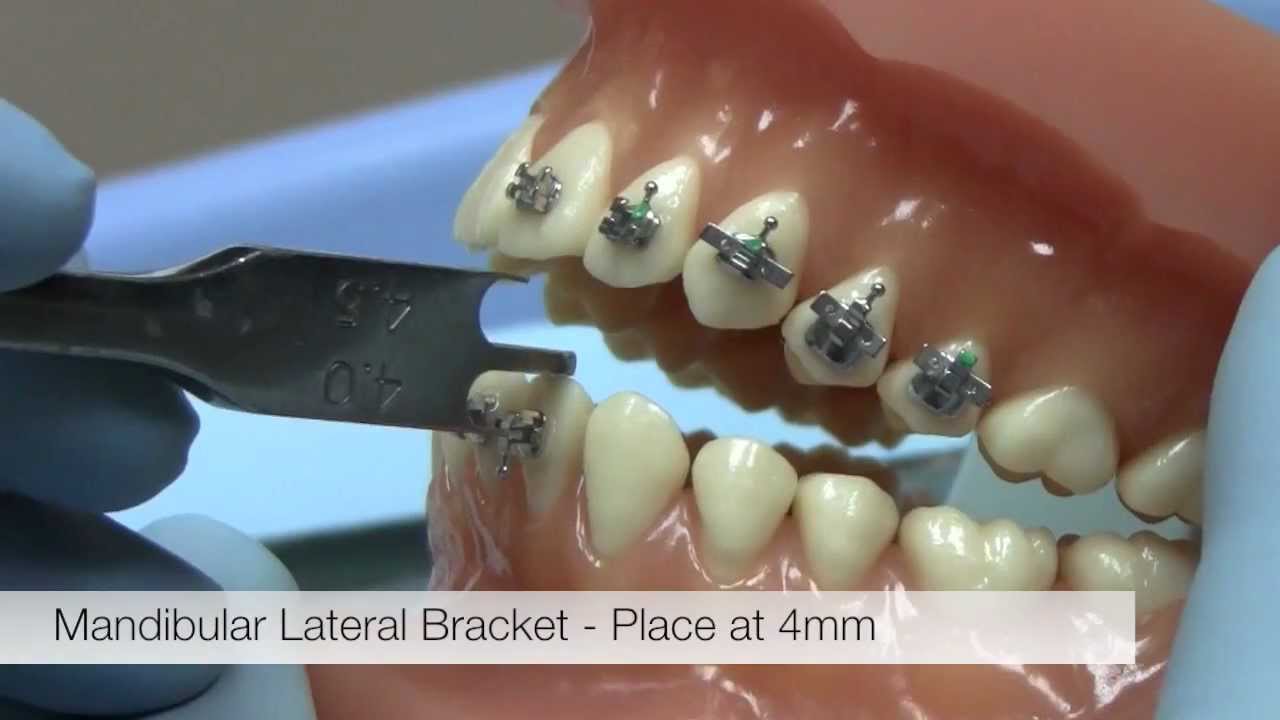American Orthodontics Alexander Lts Brackets -- Bracket Placement Video