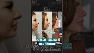 Ринопластика в Стамбуле - опыт нашей пациентки #ринопластикавтурции