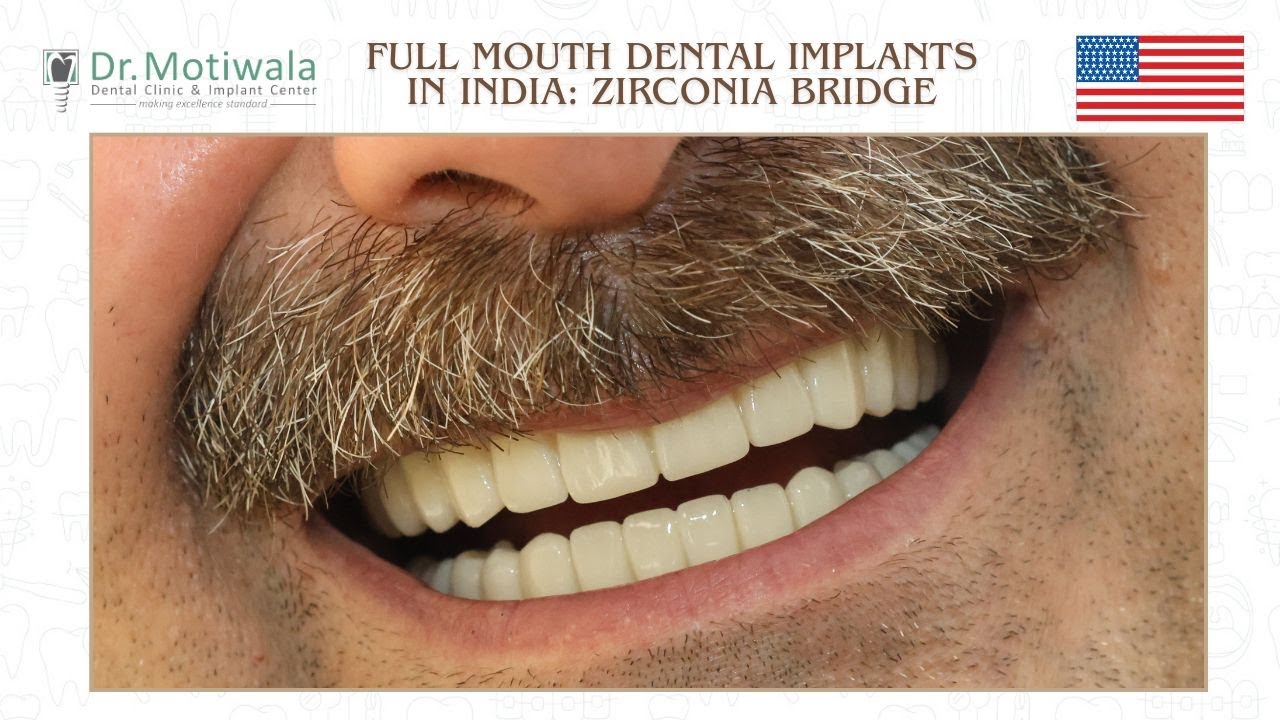 Why This American Chose India for Full Mouth Dental Implants | Graydon’s Honest Basal Implant Story