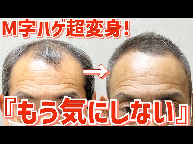 もりはげ 薄毛】気になるM字・頭頂部をワックスでモヒカンセット！ - YouTube