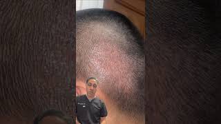 Dr. Yazdan Reviews Botched Hair Transplant on Reddit