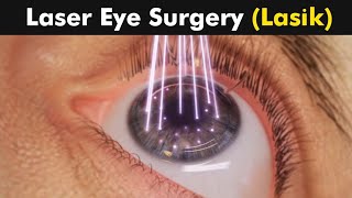 شاهد عملية الليزك (تصحيح البصر) _ LASIK eye surgery l #3d #animation