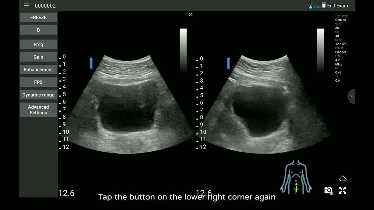 313 Measuring the bladder volume 【Norland uREzpocus User Guide】 YouTube