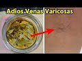 Despide Las VARICES y Los DOLORES Articular con HOJAS DE LAUREL, Es 100 % Efectivo