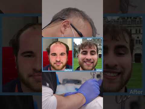 HAIR TRANSPLANT TRANSFORMATION