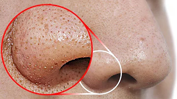 ¿Cómo se eliminan todos los puntos negros de la nariz?