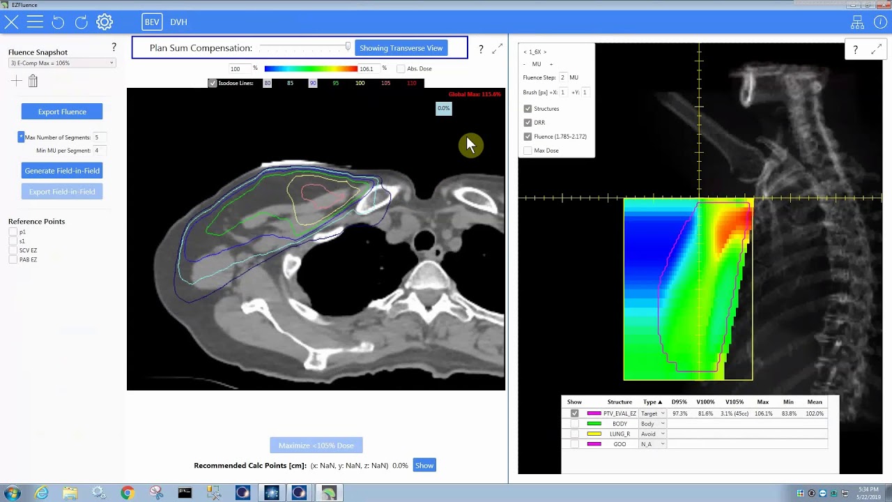 EZFluence 2.1: All-in-one 3/4 Field Breast Planning